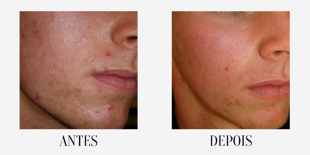 BEFORE-AFTER-acne4.png