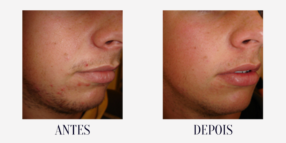 BEFORE-AFTER-acne5.png